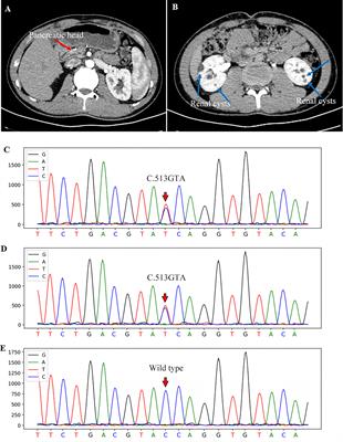 Association of Agenesis of the Dorsal Pancreas With HNF1B Heterozygote Mutation: A Case Report